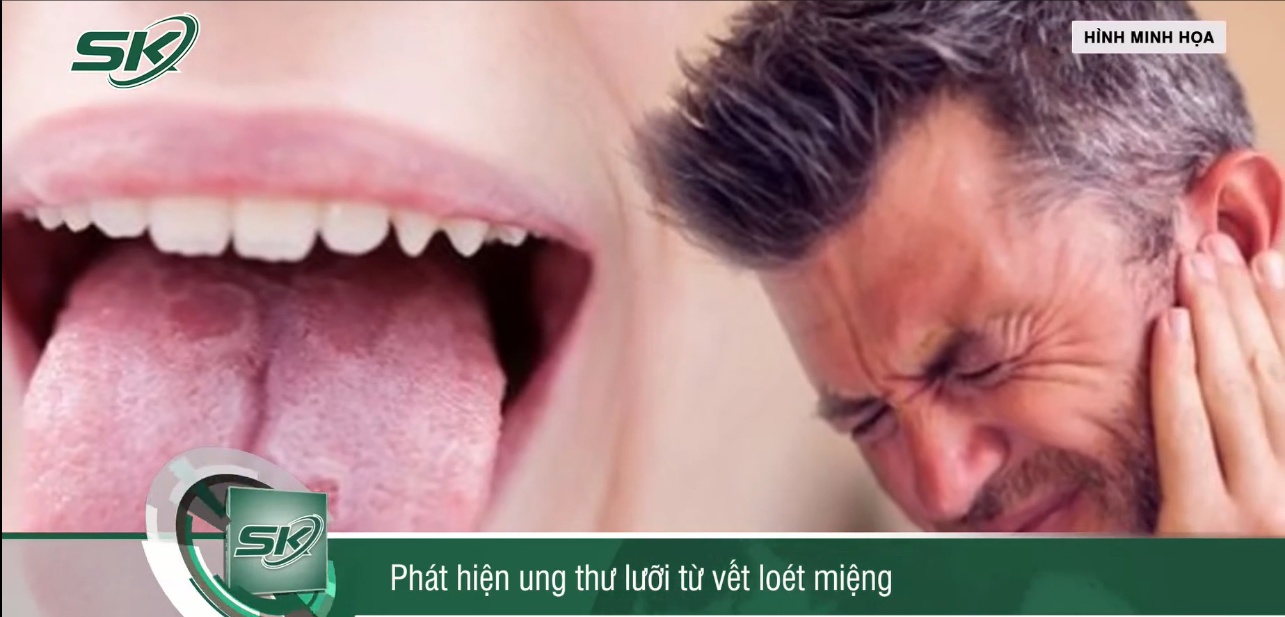 Phát hiện ung thư lưỡi từ vết loét miệng